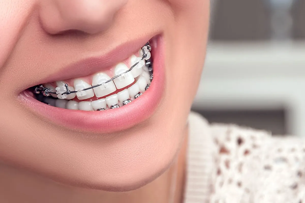 Smiling girl wearing ceramic braces