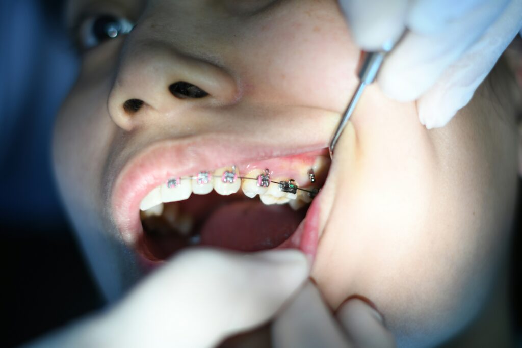 routine dental checkup of a girl wearing traditional braces on teeth, Which is one of the different types of braces