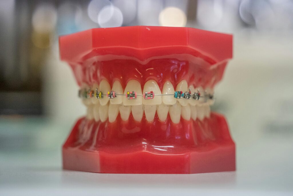 there is a dental model, with braces attached, and colorful o-rings attached to them.