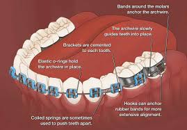 brackets are attached to the teeth, their specifications (how do braces work) is indicated by the text.