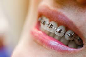 close up of woman wearing self ligating braces