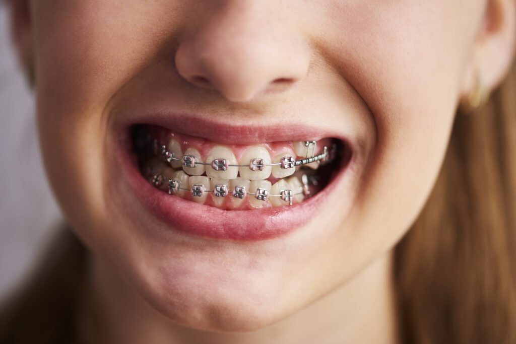 a girl smiling with braces teeth