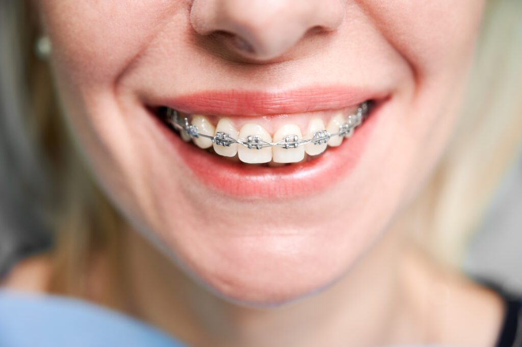 Smiling young woman with braces on her teeth.