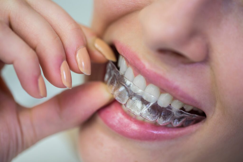 girl wearing clear aligner