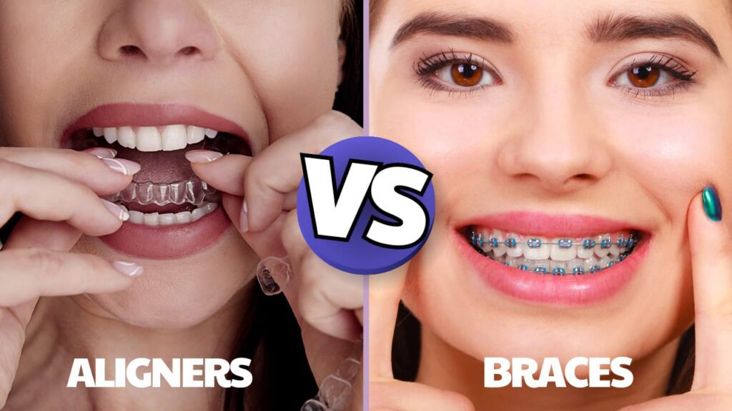 there are two girls, one wearing aligners and the other wearing braces and both smiling.