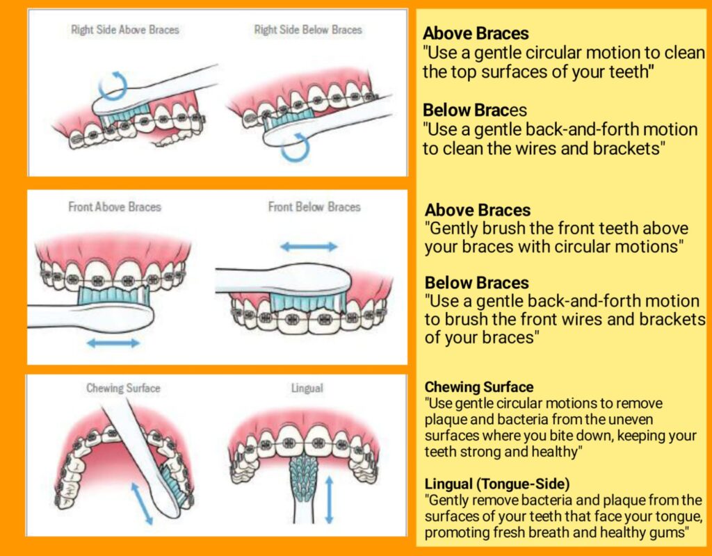 a short explanation of brushing your teeth above and below your braces, along with 3d photos