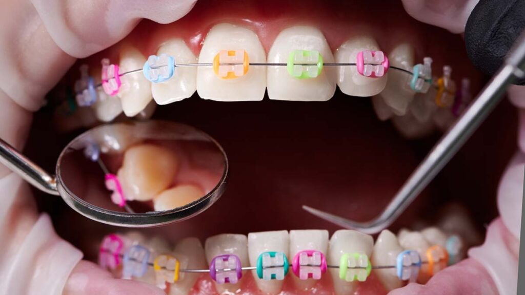 wearing braces on teeth with different colors of the band